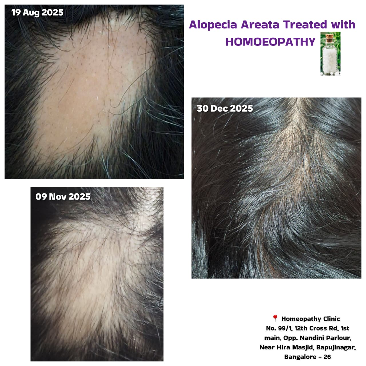 Alopecia Areata Treatment